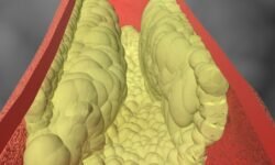 Epidemiologia do Colesterol Alto no Brasil